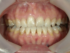 矯正歯科　アクアシステム矯正　治療後