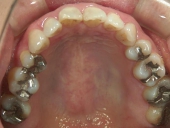 矯正歯科　治療前　上顎