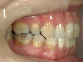 矯正歯科　治療前　右
