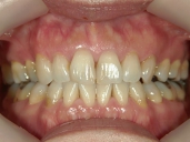 矯正歯科　治療前　正面