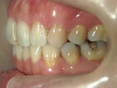 矯正歯科　治療前　左
