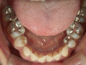 矯正歯科　治療前　下顎