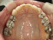 矯正歯科　治療後　上顎