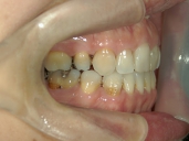 矯正歯科　治療後　右