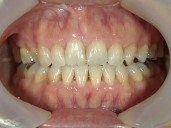 矯正歯科　治療後　正面