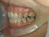 矯正歯科　治療後　左