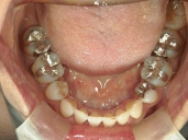 矯正歯科　治療後　下顎