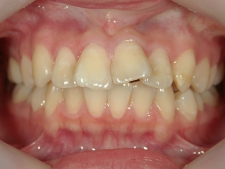 矯正歯科　治療前