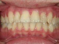 矯正歯科　プチワイヤー矯正　治療後