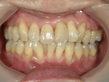 矯正歯科　治療前