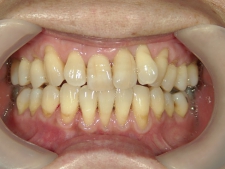 矯正歯科　プチワイヤー矯正　治療後