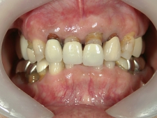 矯正歯科　治療前