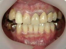 矯正歯科　治療前