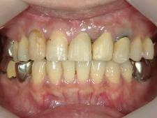 矯正歯科　プチワイヤー矯正　治療後