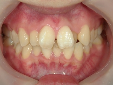 矯正歯科　治療前