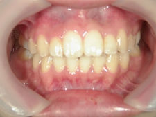 矯正歯科　プチワイヤー矯正　治療後