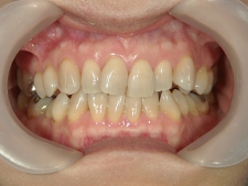 矯正歯科　治療前