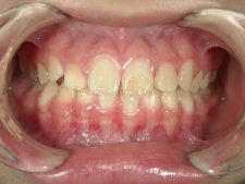 矯正歯科　治療前