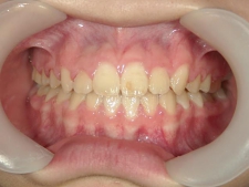 矯正歯科　全顎ワイヤー矯正　治療後