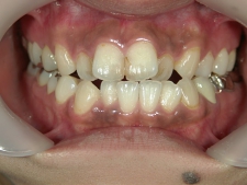 矯正歯科　治療前