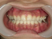 矯正歯科　全顎ワイヤー矯正　治療後