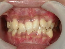 矯正歯科　治療前