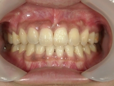 矯正歯科　全顎ワイヤー矯正　治療後