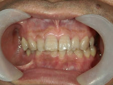 矯正歯科　治療前