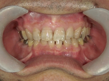 矯正歯科　全顎ワイヤー矯正　治療後