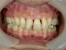 矯正歯科　治療前