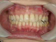 矯正歯科　全顎ワイヤー矯正　治療後