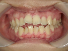 矯正歯科　治療前