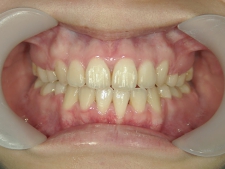 矯正歯科　全顎ワイヤー矯正　治療後