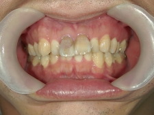 矯正歯科　治療前