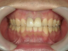 矯正歯科　全顎ワイヤー矯正　治療後