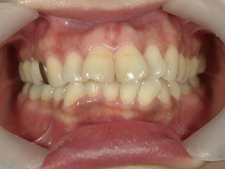 矯正歯科　治療前