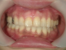 矯正歯科　プチワイヤー矯正　治療後