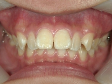 矯正歯科　治療前