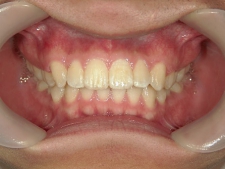 矯正歯科　プチワイヤー矯正　治療後