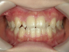 矯正歯科　治療前