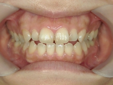 矯正歯科　治療前