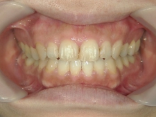 矯正歯科　プチワイヤー矯正　治療後