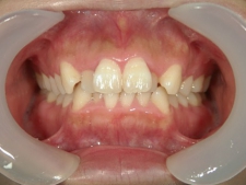 矯正歯科　治療前