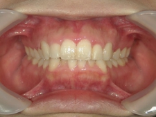 矯正歯科　プチワイヤー矯正　治療後