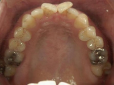 矯正歯科　治療前