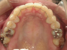 矯正歯科　プチワイヤー矯正　治療後