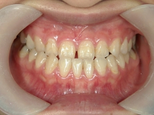 矯正歯科　治療前