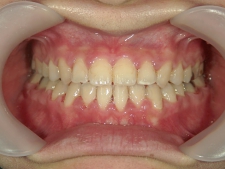 矯正歯科　全顎ワイヤー矯正　治療後