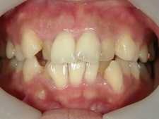 矯正歯科　治療前