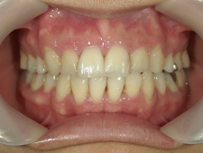 矯正歯科　全顎ワイヤー矯正　治療後